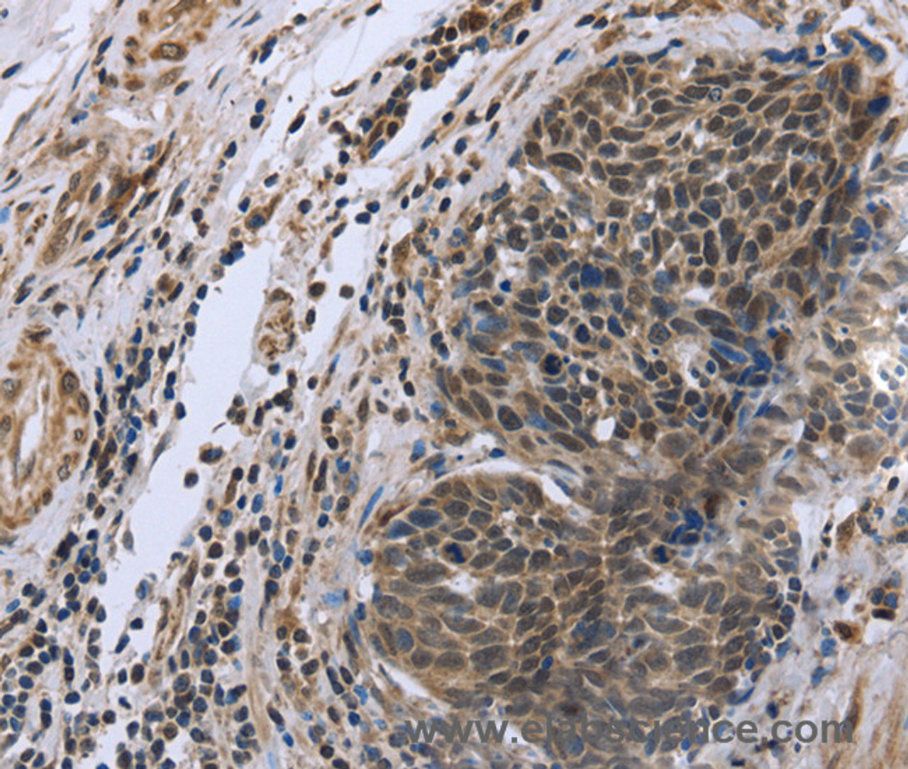 Immunohistochemistry of paraffin-embedded Human cervical cancer tissue using FANCG Polyclonal Antibody at dilution 1:50