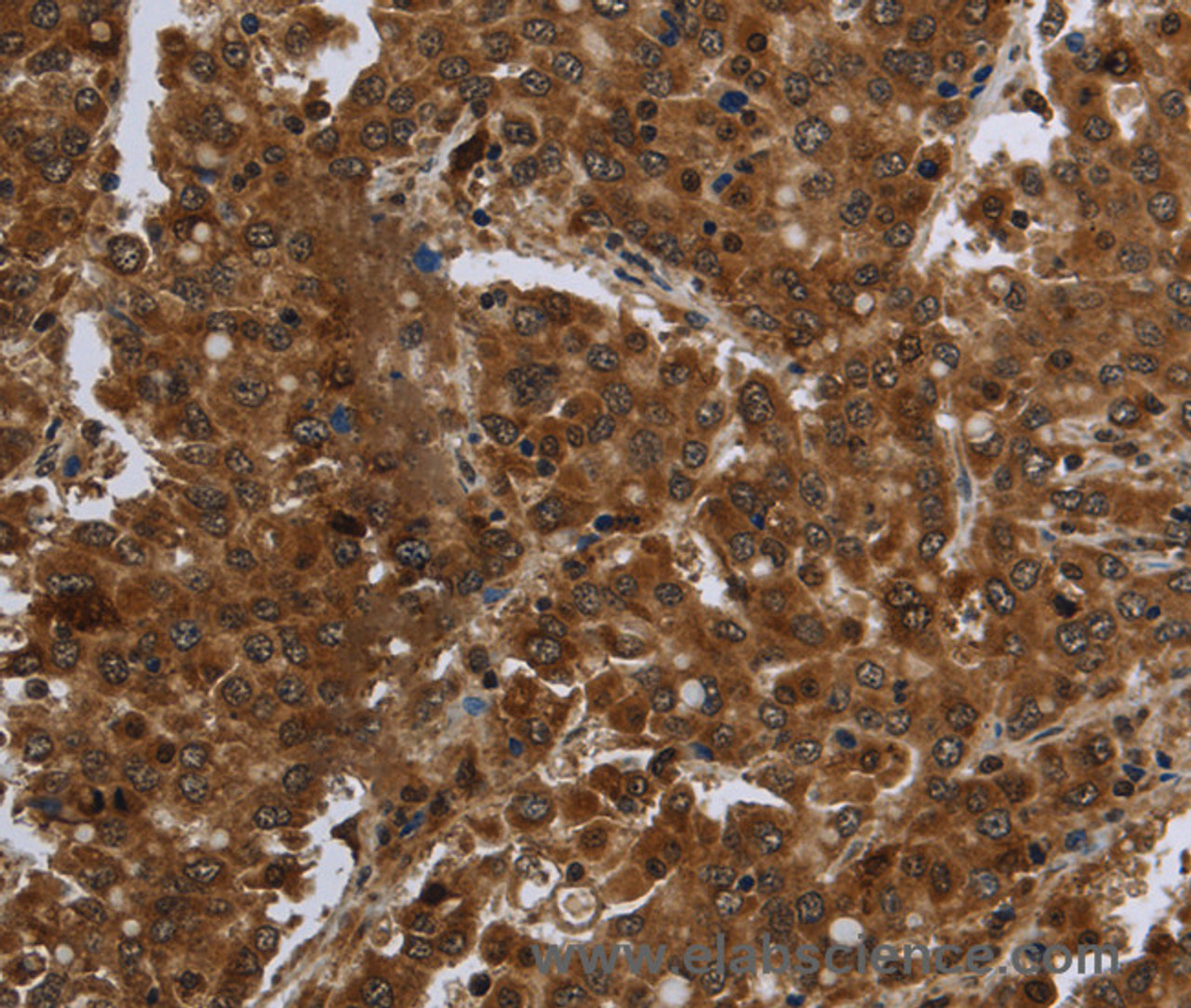 Immunohistochemistry of paraffin-embedded Human liver cancer tissue using FASTKD1 Polyclonal Antibody at dilution 1:60