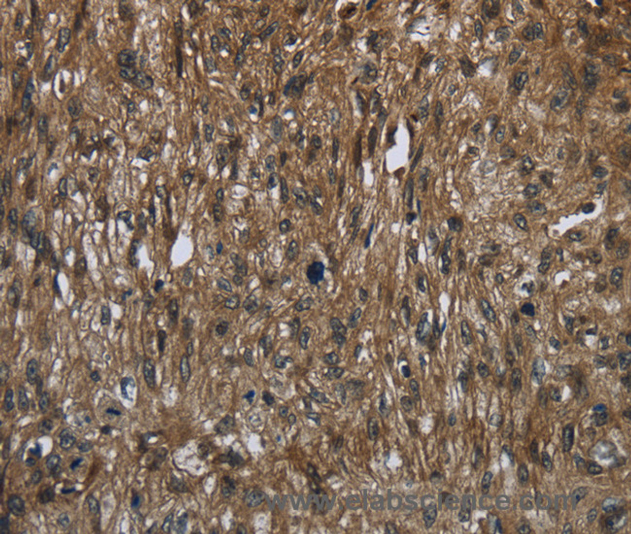 Immunohistochemistry of paraffin-embedded Human esophagus cancer tissue using FASTKD2 Polyclonal Antibody at dilution 1:50