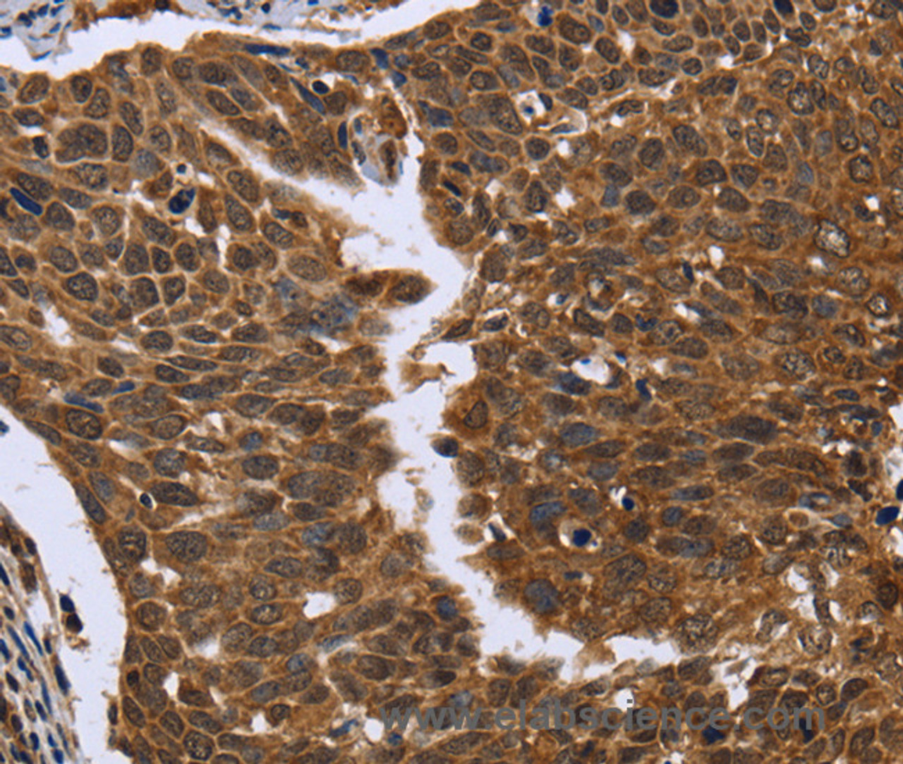 Immunohistochemistry of paraffin-embedded Human cervical cancer tissue using FGFR1OP Polyclonal Antibody at dilution 1:50