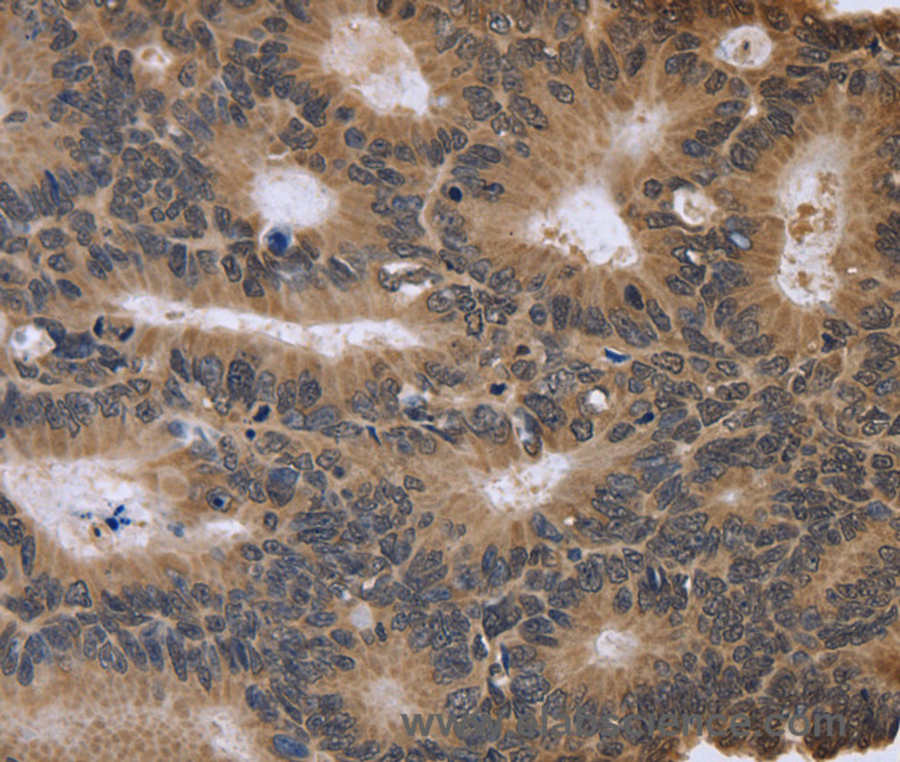 Immunohistochemistry of paraffin-embedded Human colon cancer tissue using FGFR1OP2 Polyclonal Antibody at dilution 1:40