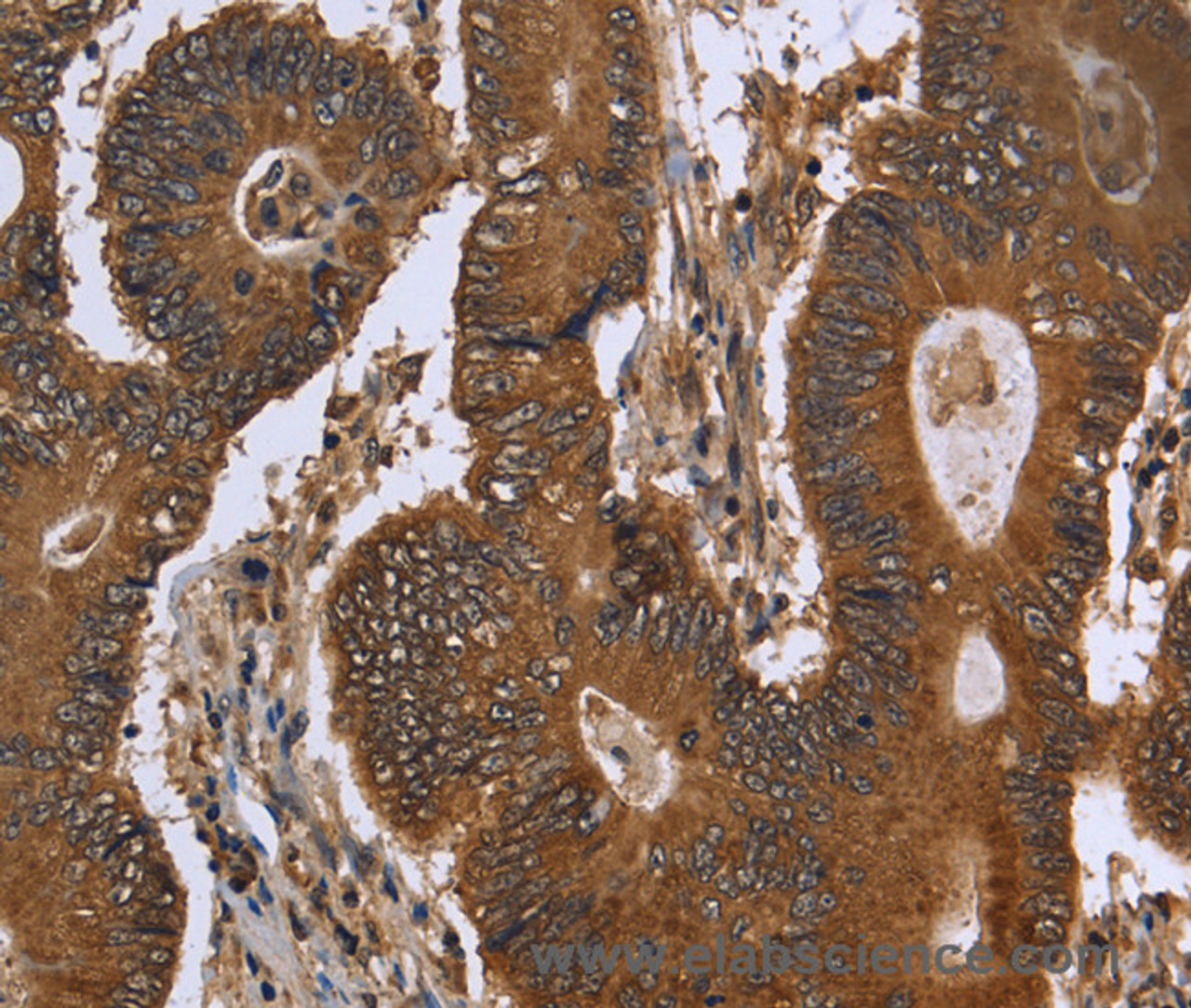 Immunohistochemistry of paraffin-embedded Human colon cancer using FGFRL1 Polyclonal Antibody at dilution of 1:40