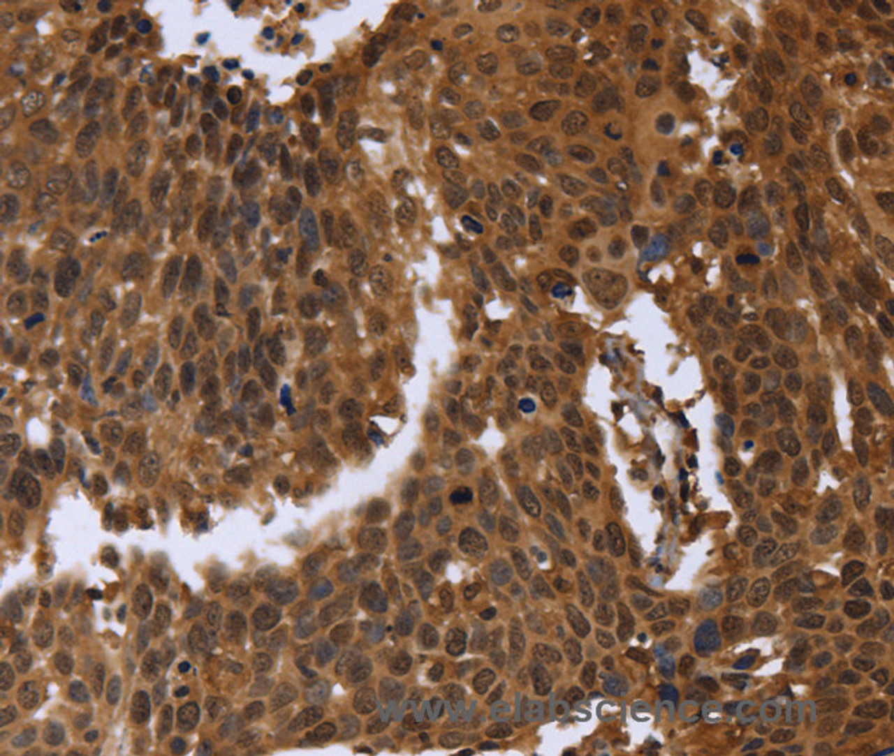 Immunohistochemistry of paraffin-embedded Human cervical cancer using FGFRL1 Polyclonal Antibody at dilution of 1:40