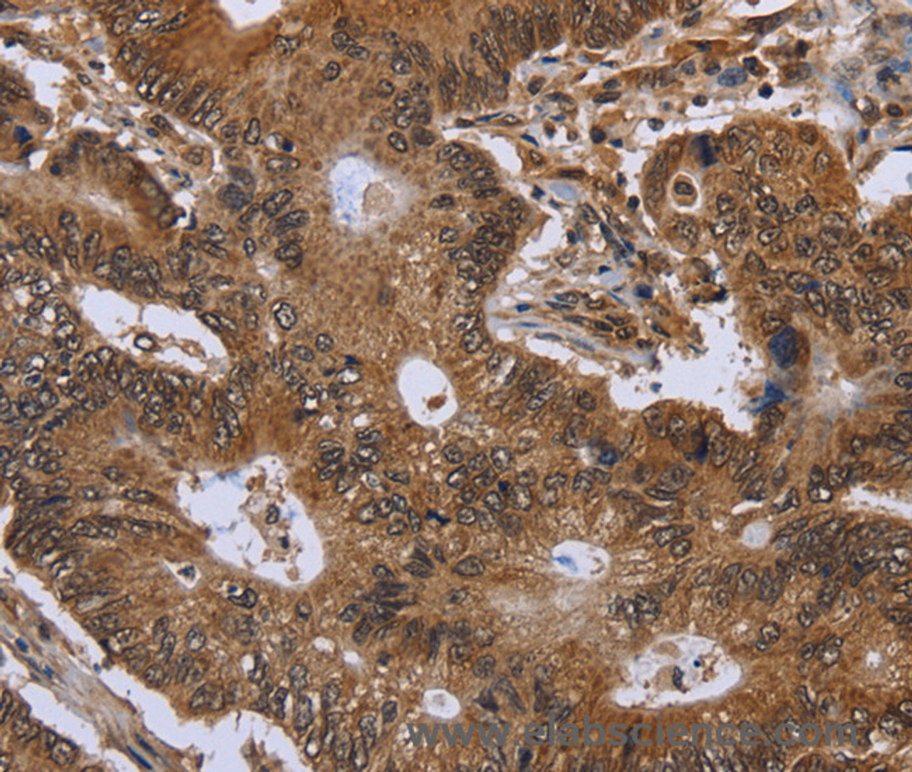 Immunohistochemistry of paraffin-embedded Human colon cancer using FHIT Polyclonal Antibody at dilution of 1:30