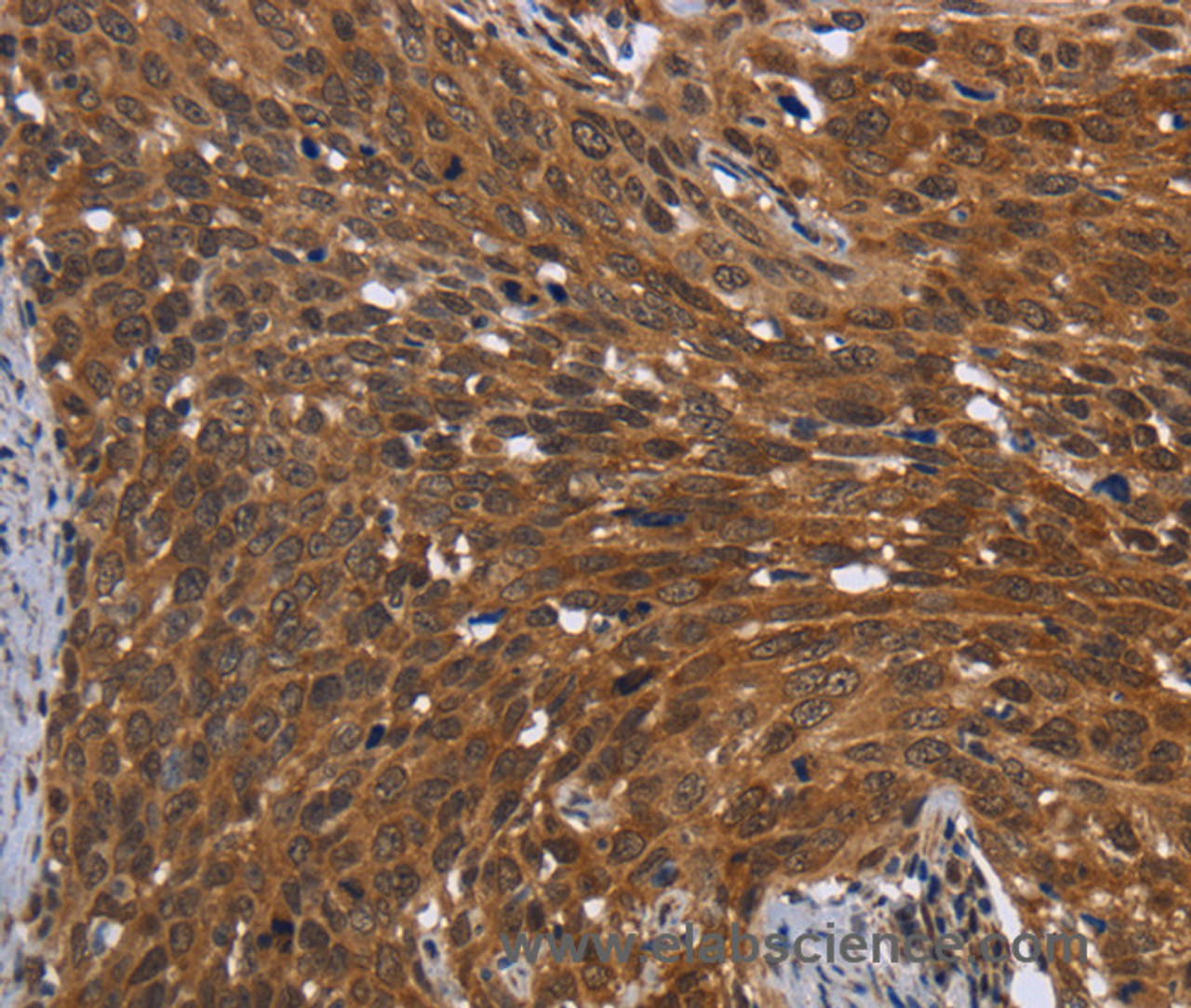 Immunohistochemistry of paraffin-embedded Human cervical cancer using FHIT Polyclonal Antibody at dilution of 1:30