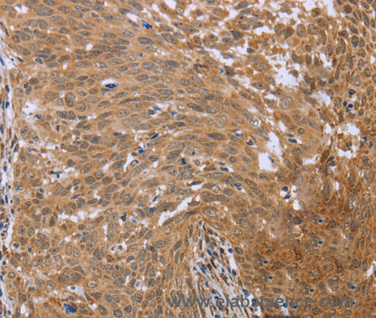 Immunohistochemistry of paraffin-embedded Human cervical cancer using FHL2 Polyclonal Antibody at dilution of 1:40