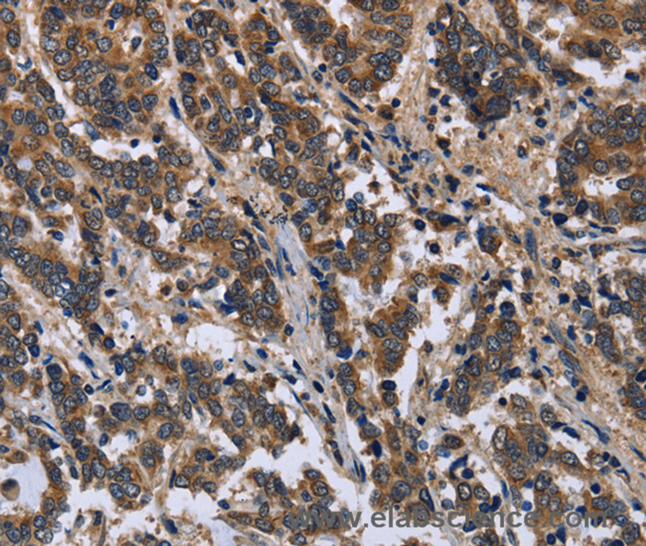 Immunohistochemistry of paraffin-embedded Human liver cancer using FRK Polyclonal Antibody at dilution of 1:50