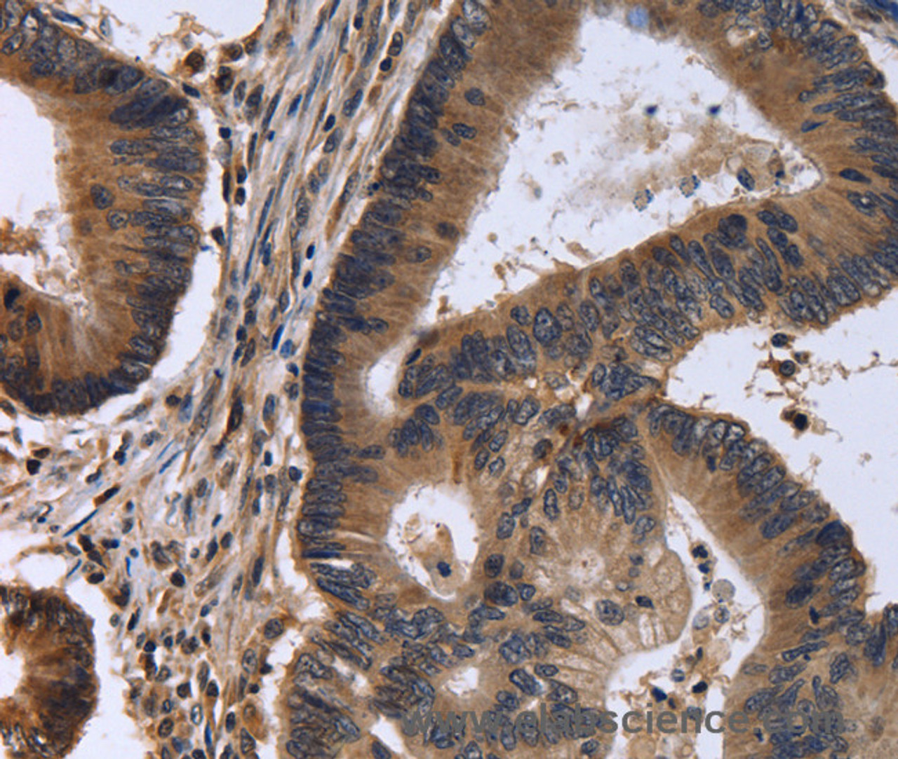 Immunohistochemistry of paraffin-embedded Human colon cancer tissue using FSTL1 Polyclonal Antibody at dilution 1:30