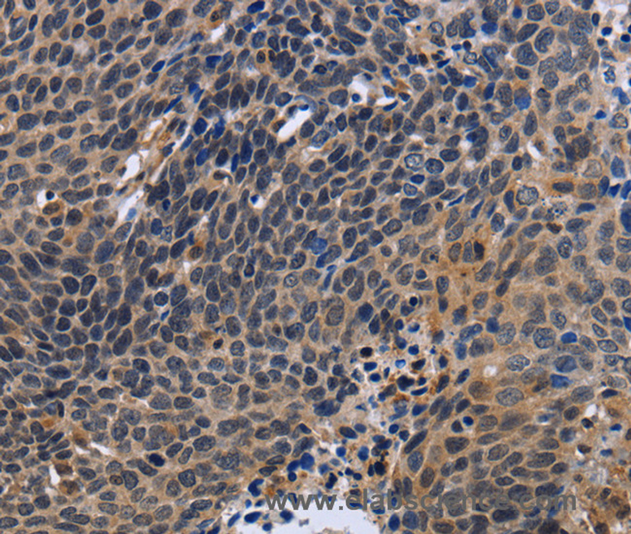 Immunohistochemistry of paraffin-embedded Human cervical cancer tissue using FSTL1 Polyclonal Antibody at dilution 1:30