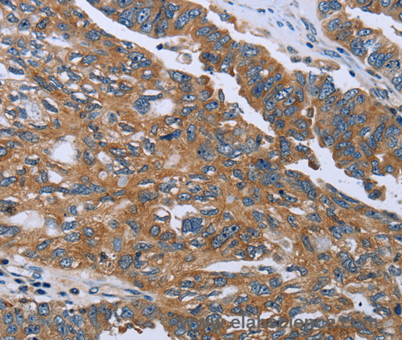 Immunohistochemistry of paraffin-embedded Human ovarian cancer using GAB2 Polyclonal Antibody at dilution of 1:40