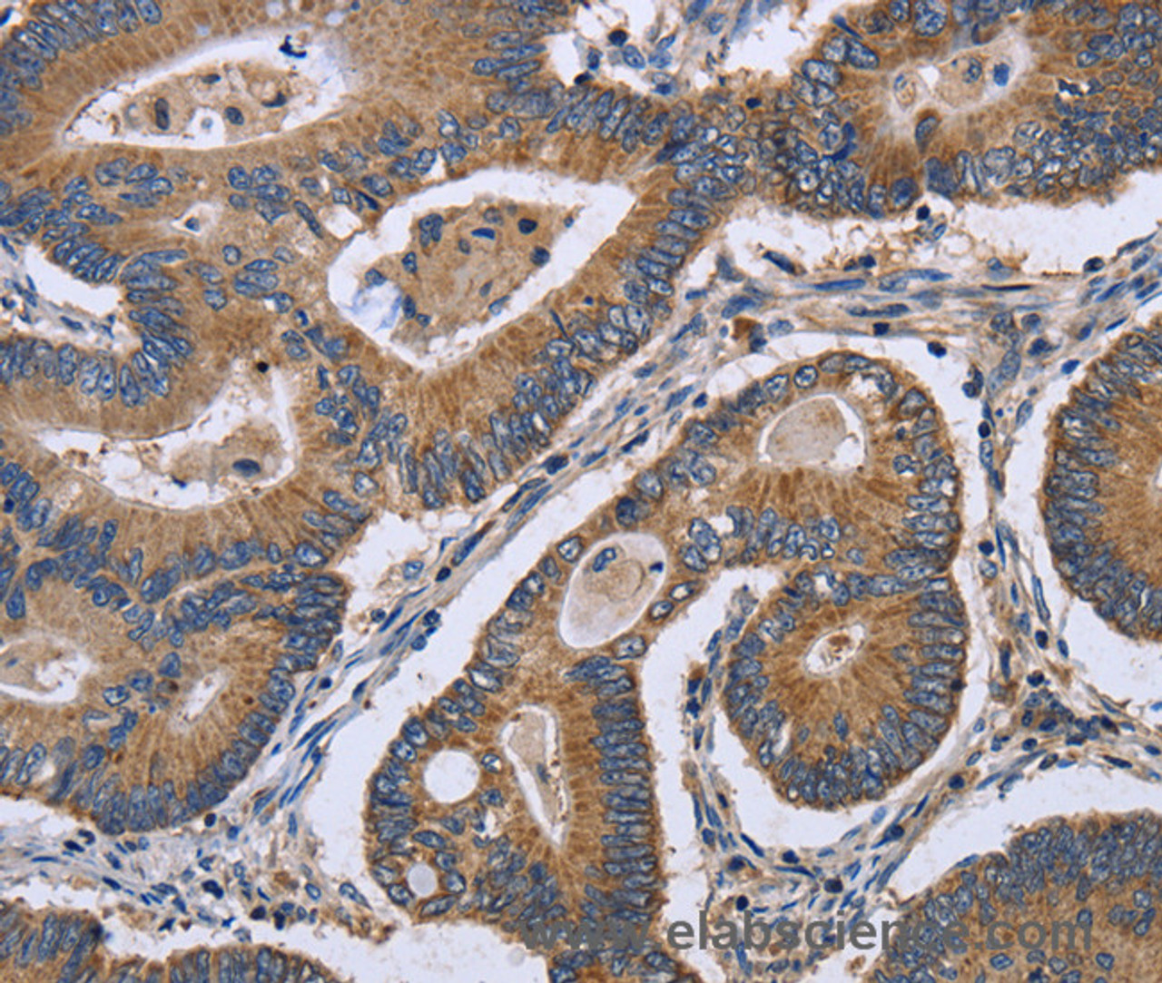 Immunohistochemistry of paraffin-embedded Human colon cancer using GABPB2 Polyclonal Antibody at dilution of 1:30