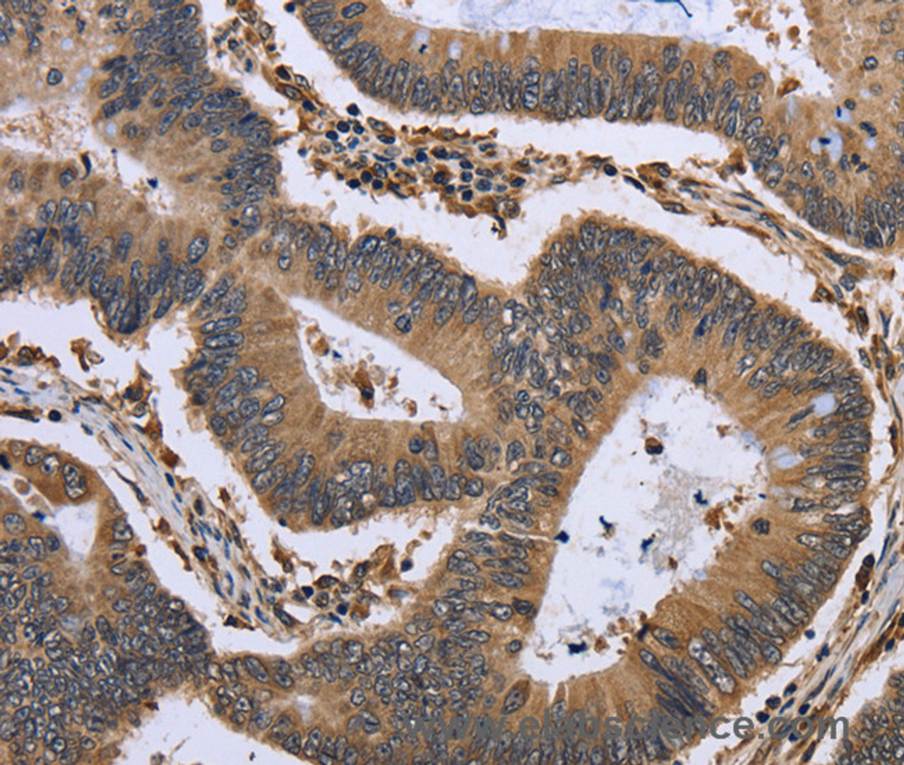 Immunohistochemistry of paraffin-embedded Human colon cancer tissue using GADD45B Polyclonal Antibody at dilution 1:30
