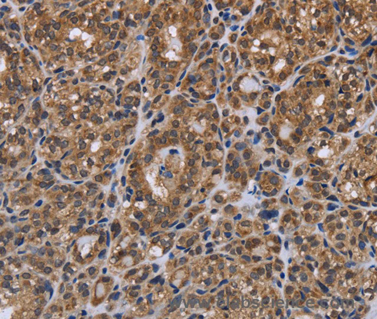 Immunohistochemistry of paraffin-embedded Human thyroid cancer using GALK1 Polyclonal Antibody at dilution of 1:40