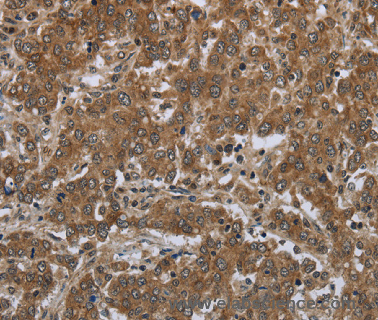 Immunohistochemistry of paraffin-embedded Human liver cancer tissue using GABRB1 Polyclonal Antibody at dilution 1:50