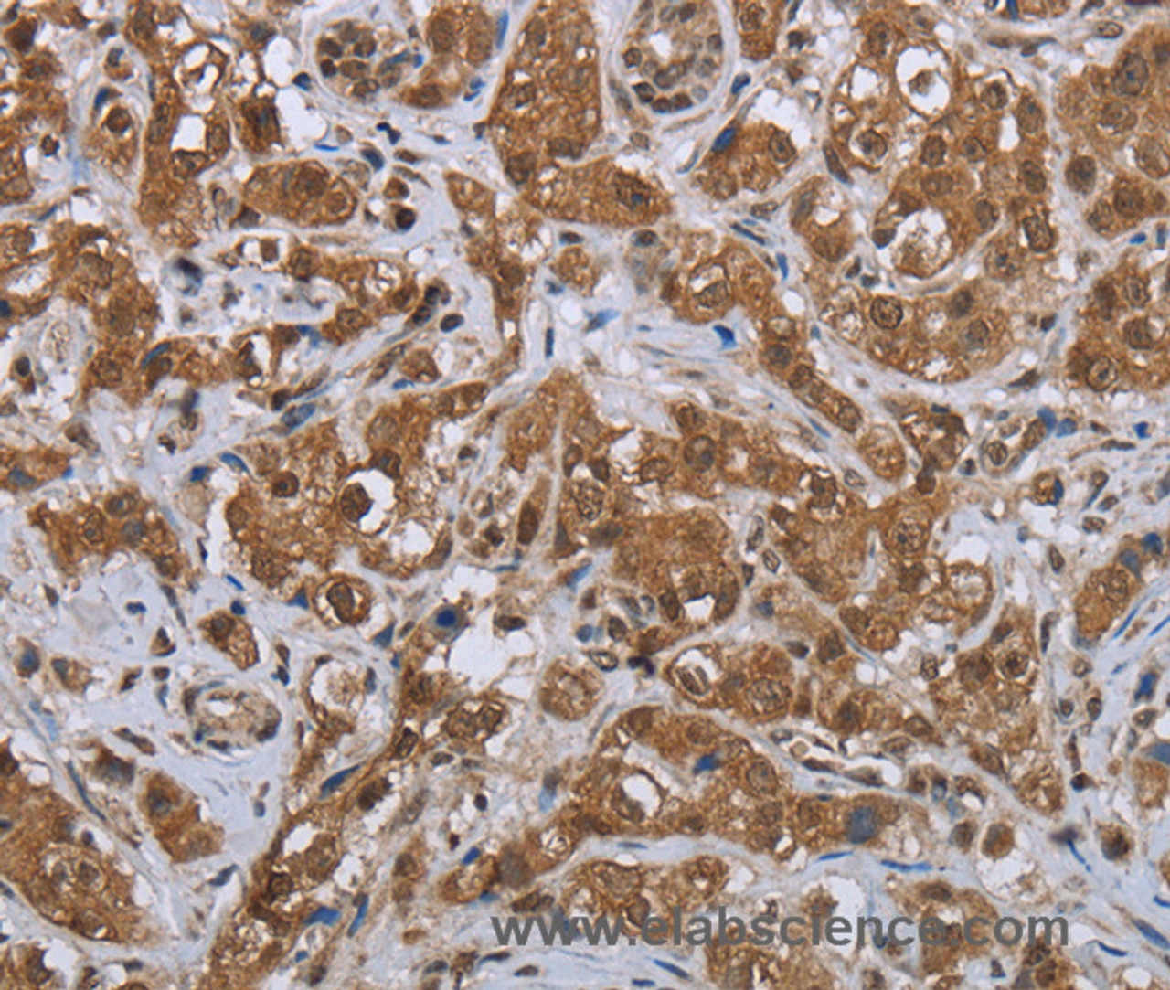 Immunohistochemistry of paraffin-embedded Human breast cancer tissue using GABRB1 Polyclonal Antibody at dilution 1:50