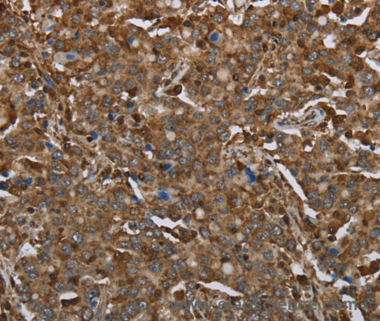 Immunohistochemistry of paraffin-embedded Human liver cancer using ARHGDIA Polyclonal Antibody at dilution of 1:30