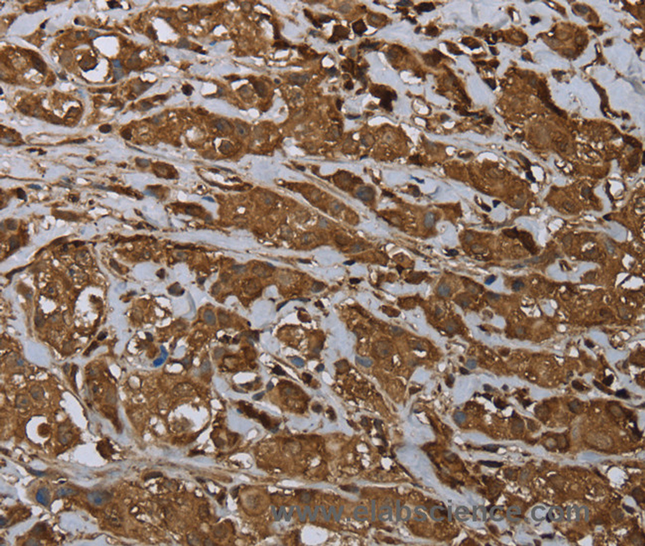 Immunohistochemistry of paraffin-embedded Human breast cancer using ARHGDIA Polyclonal Antibody at dilution of 1:30