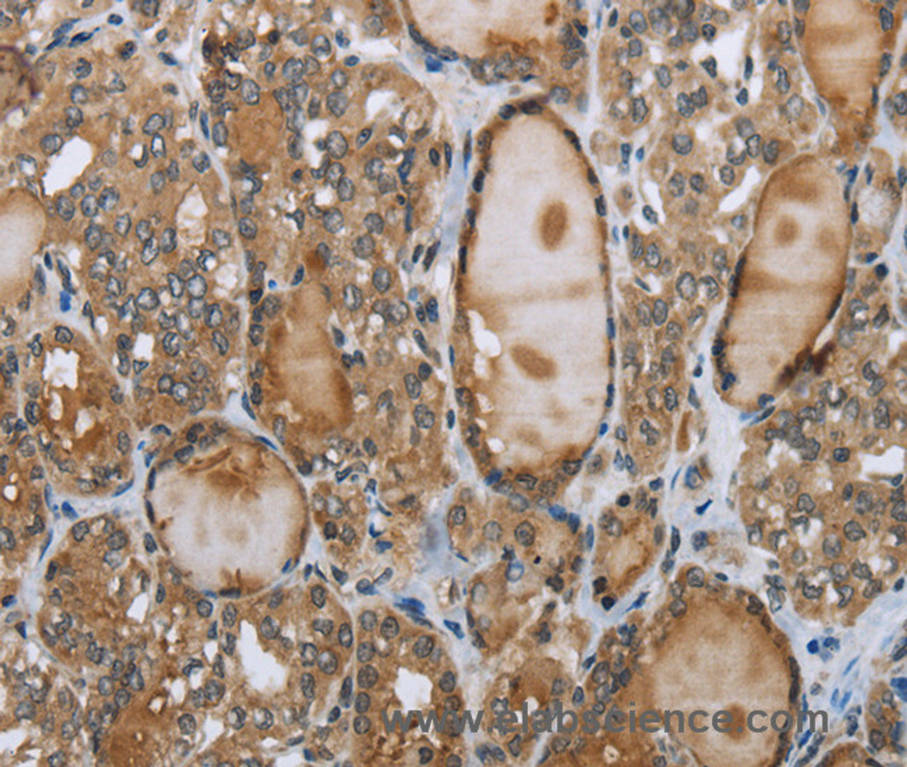 Immunohistochemistry of paraffin-embedded Human thyroid cancer using GGT1 Polyclonal Antibody at dilution of 1:40