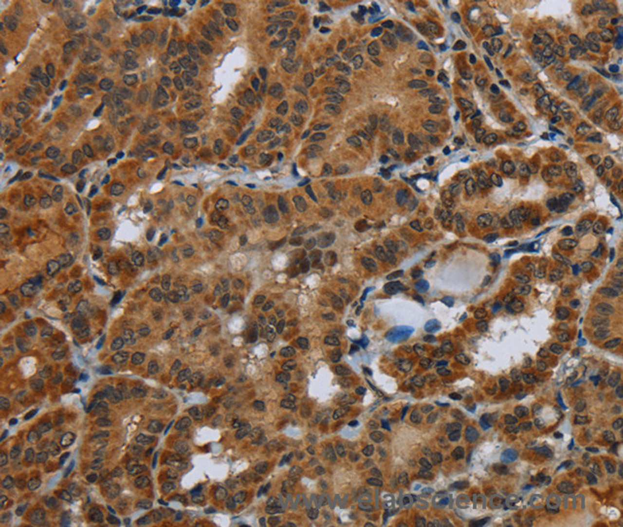 Immunohistochemistry of paraffin-embedded Human thyroid cancer tissue using Glucocorticoid Receptor Polyclonal Antibody at dilution 1:40