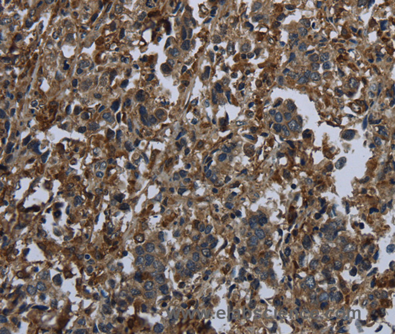 Immunohistochemistry of paraffin-embedded Human liver cancer using GLUL Polyclonal Antibody at dilution of 1:60