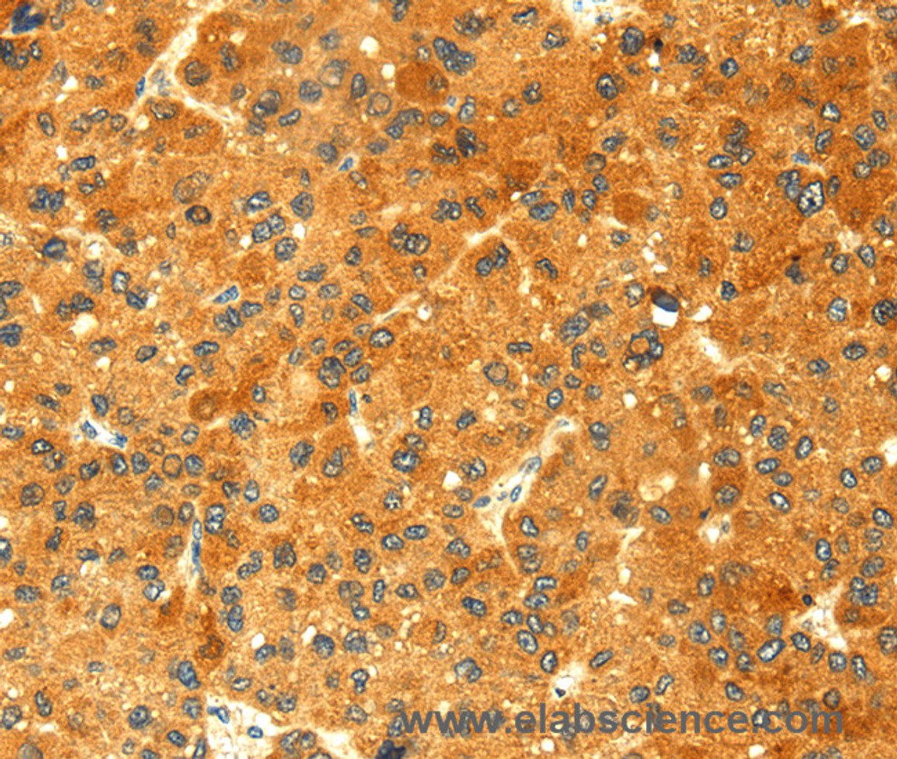 Immunohistochemistry of paraffin-embedded Human liver cancer tissue using GK1 Polyclonal Antibody at dilution 1:60