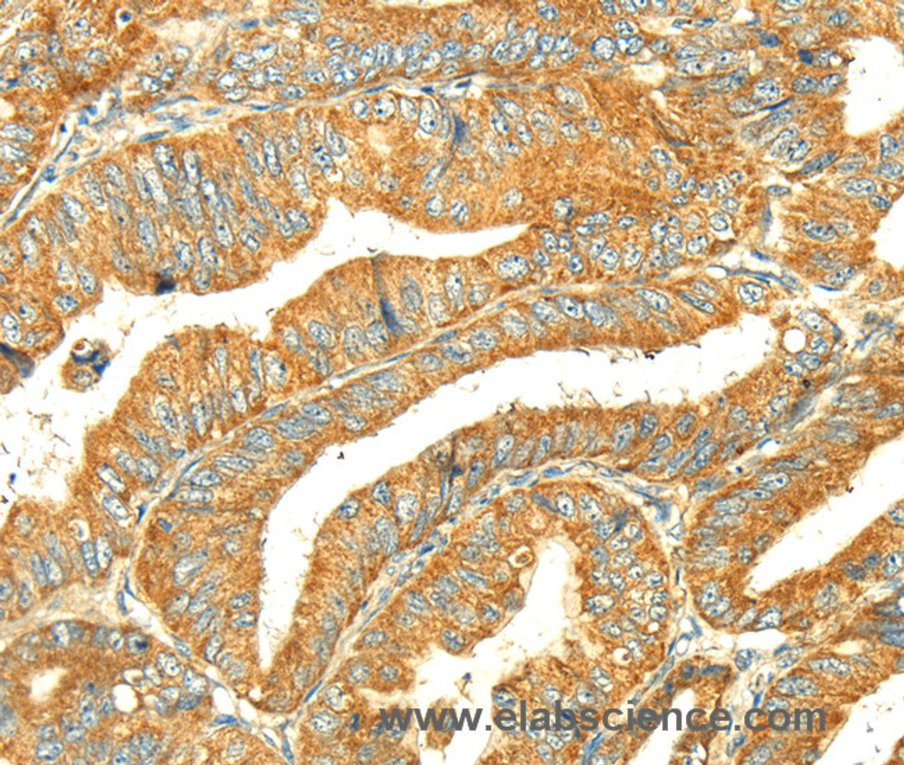 Immunohistochemistry of paraffin-embedded Human colon cancer tissue using GK1 Polyclonal Antibody at dilution 1:60