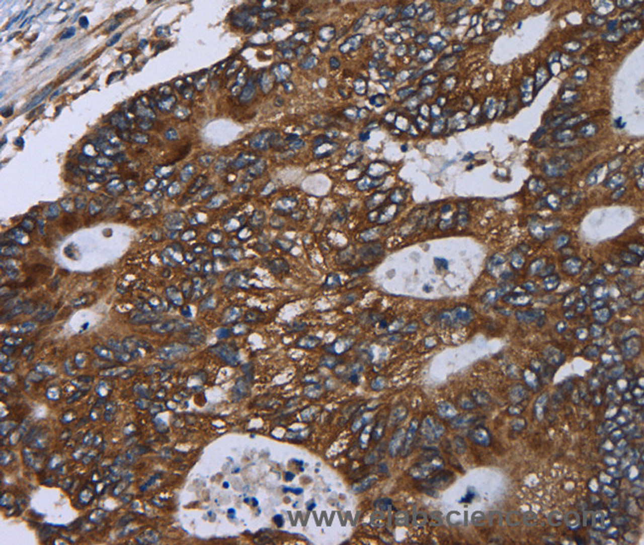 Immunohistochemistry of paraffin-embedded Human colon cancer using GOLGA2 Polyclonal Antibody at dilution of 1:60