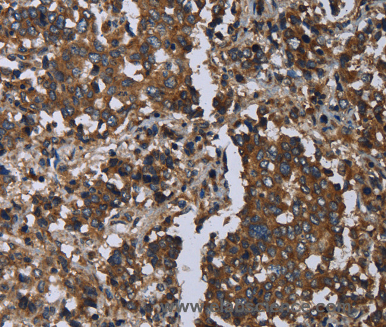 Immunohistochemistry of paraffin-embedded Human liver cancer using GOLGA2 Polyclonal Antibody at dilution of 1:60