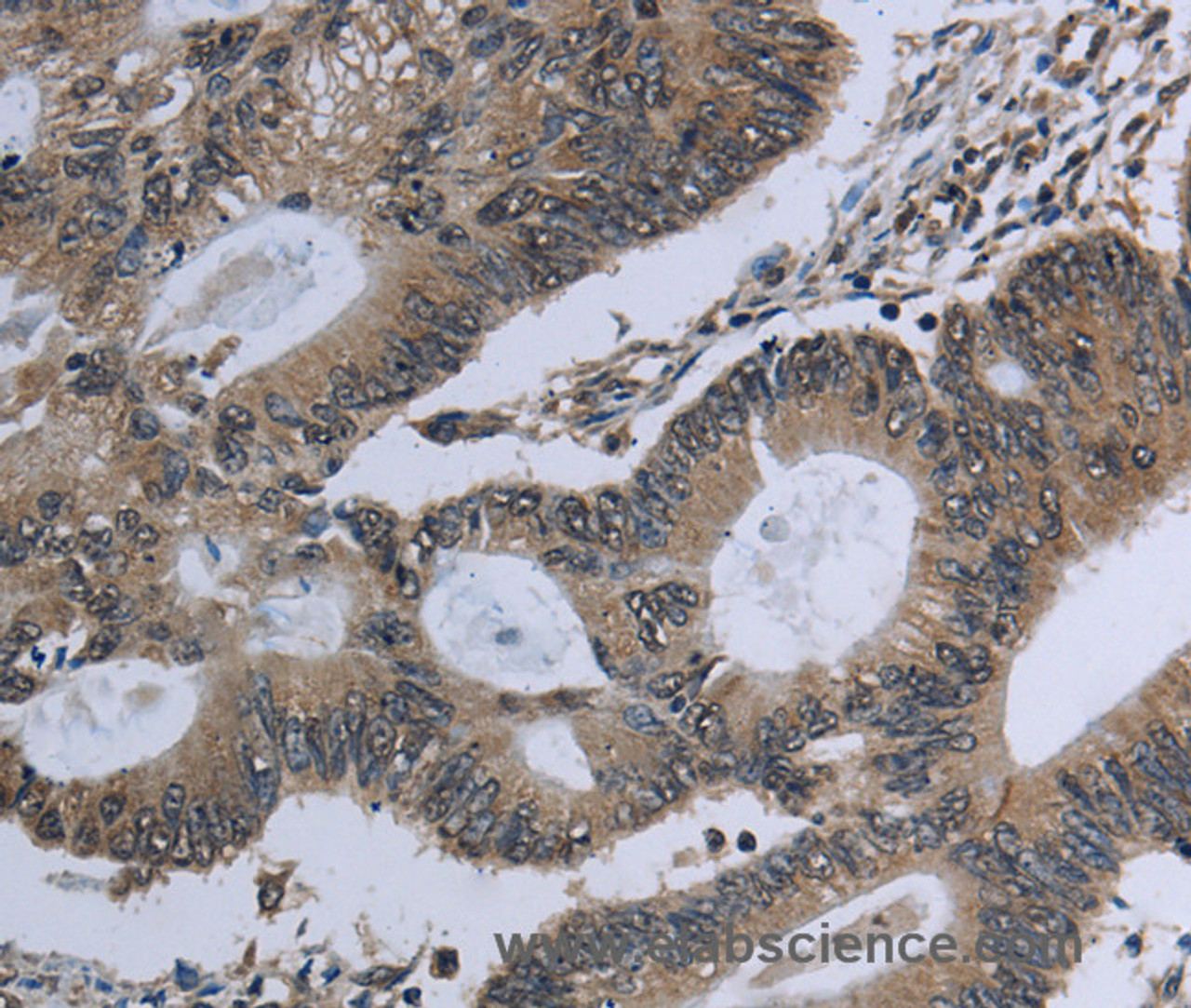 Immunohistochemistry of paraffin-embedded Human colon cancer using GNG2 Polyclonal Antibody at dilution of 1:60