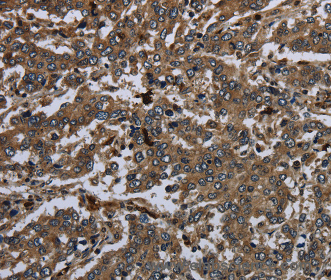 Immunohistochemistry of paraffin-embedded Human liver cancer using CD42b Polyclonal Antibody at dilution of 1:60