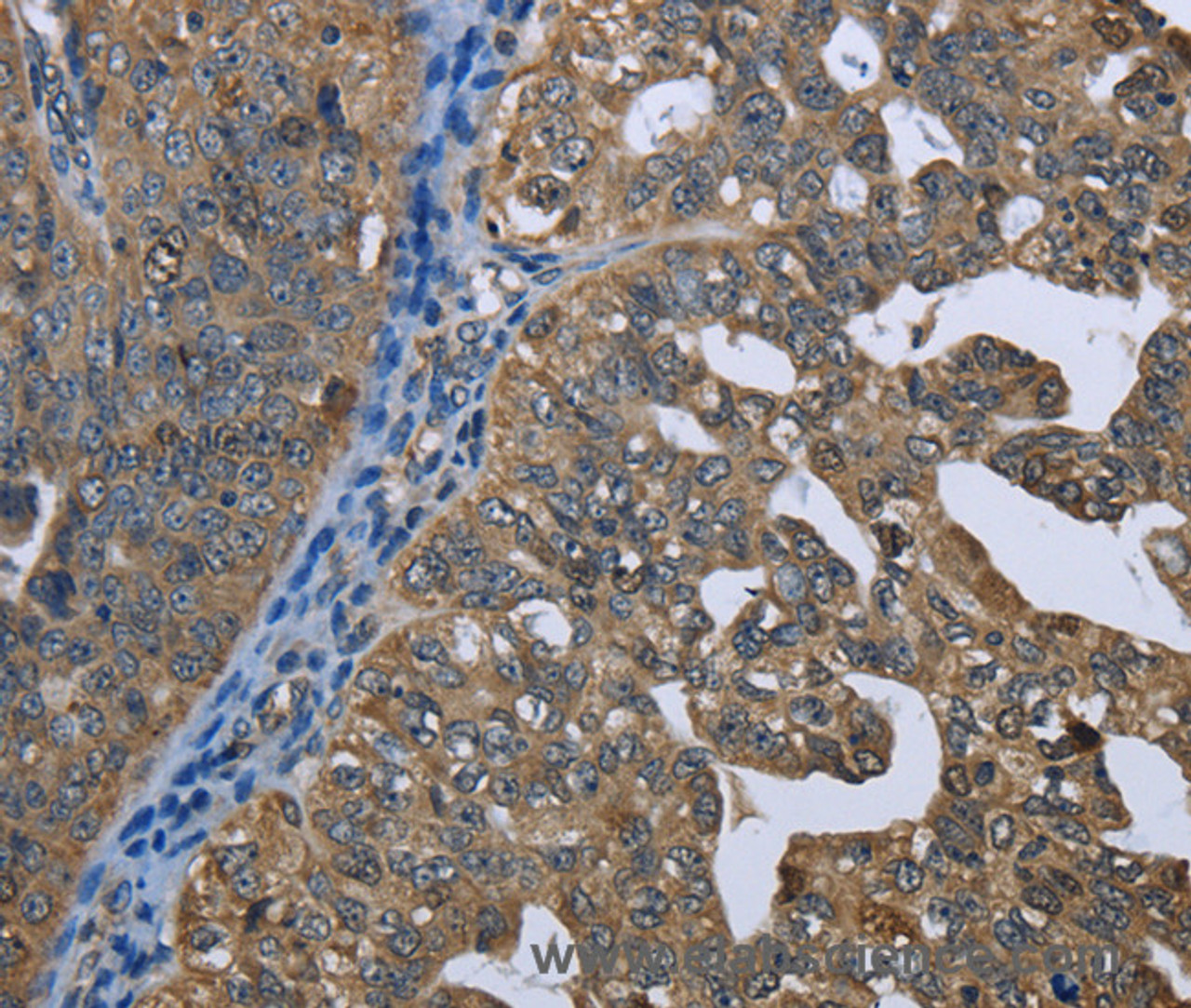 Immunohistochemistry of paraffin-embedded Human ovarian cancer tissue using GPAM Polyclonal Antibody at dilution 1:60