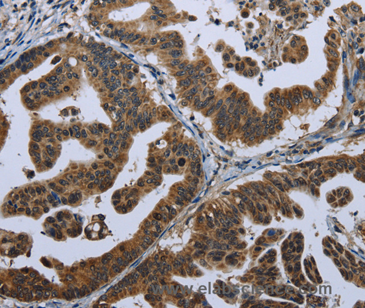 Immunohistochemistry of paraffin-embedded Human gastric cancer tissue using GPAM Polyclonal Antibody at dilution 1:60