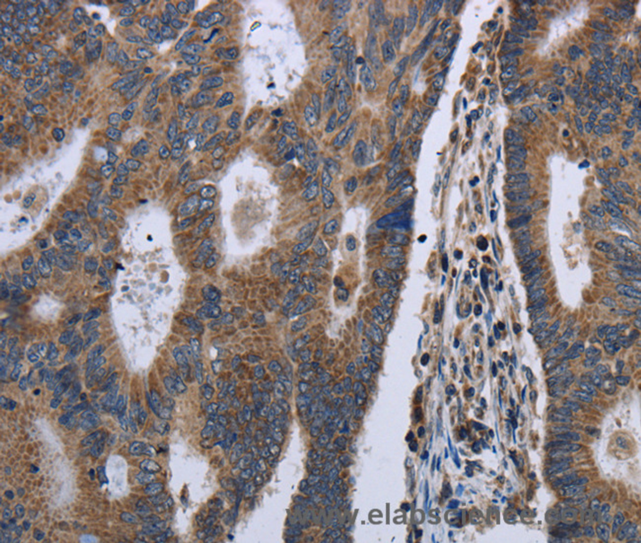 Immunohistochemistry of paraffin-embedded Human colon cancer using GSTA3 Polyclonal Antibody at dilution of 1:30