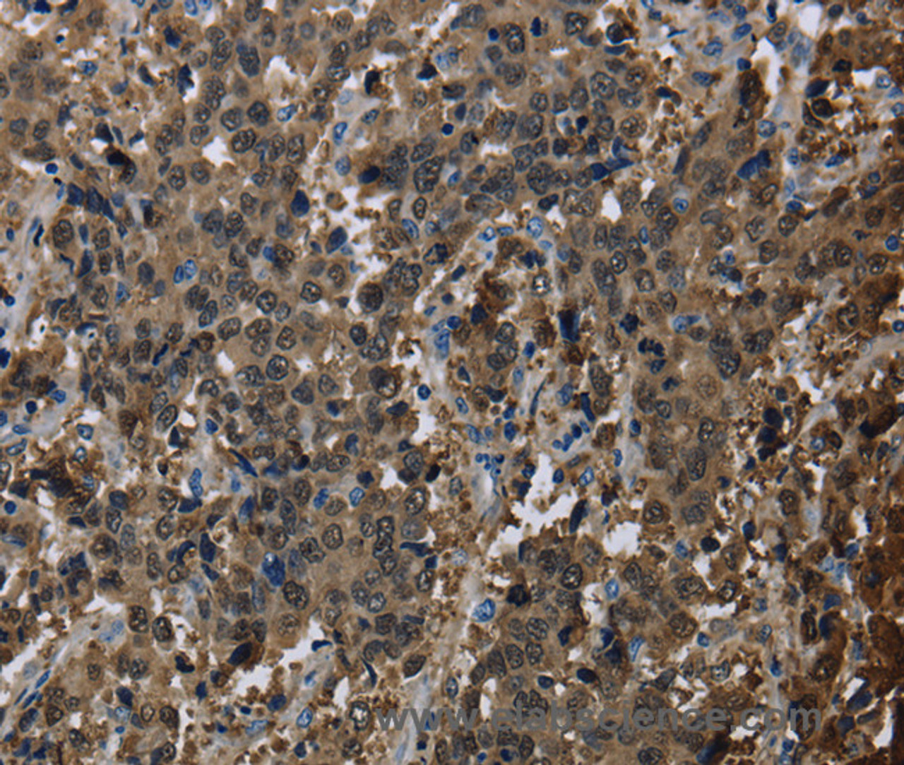 Immunohistochemistry of paraffin-embedded Human liver cancer using GSTA3 Polyclonal Antibody at dilution of 1:30