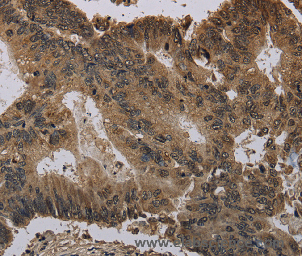 Immunohistochemistry of paraffin-embedded Human colon cancer using Histone H4 Polyclonal Antibody at dilution of 1:30