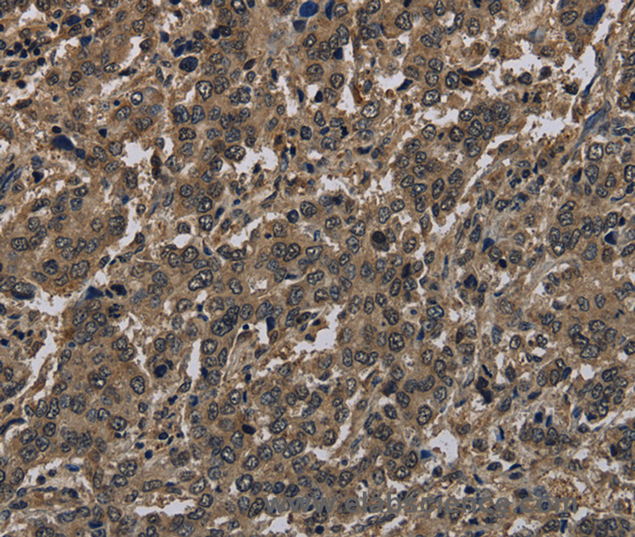 Immunohistochemistry of paraffin-embedded Human liver cancer using Histone H4 Polyclonal Antibody at dilution of 1:30