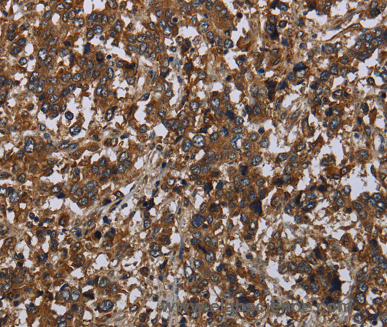 Immunohistochemistry of paraffin-embedded Human liver cancer tissue using HOMER2 Polyclonal Antibody at dilution 1:40