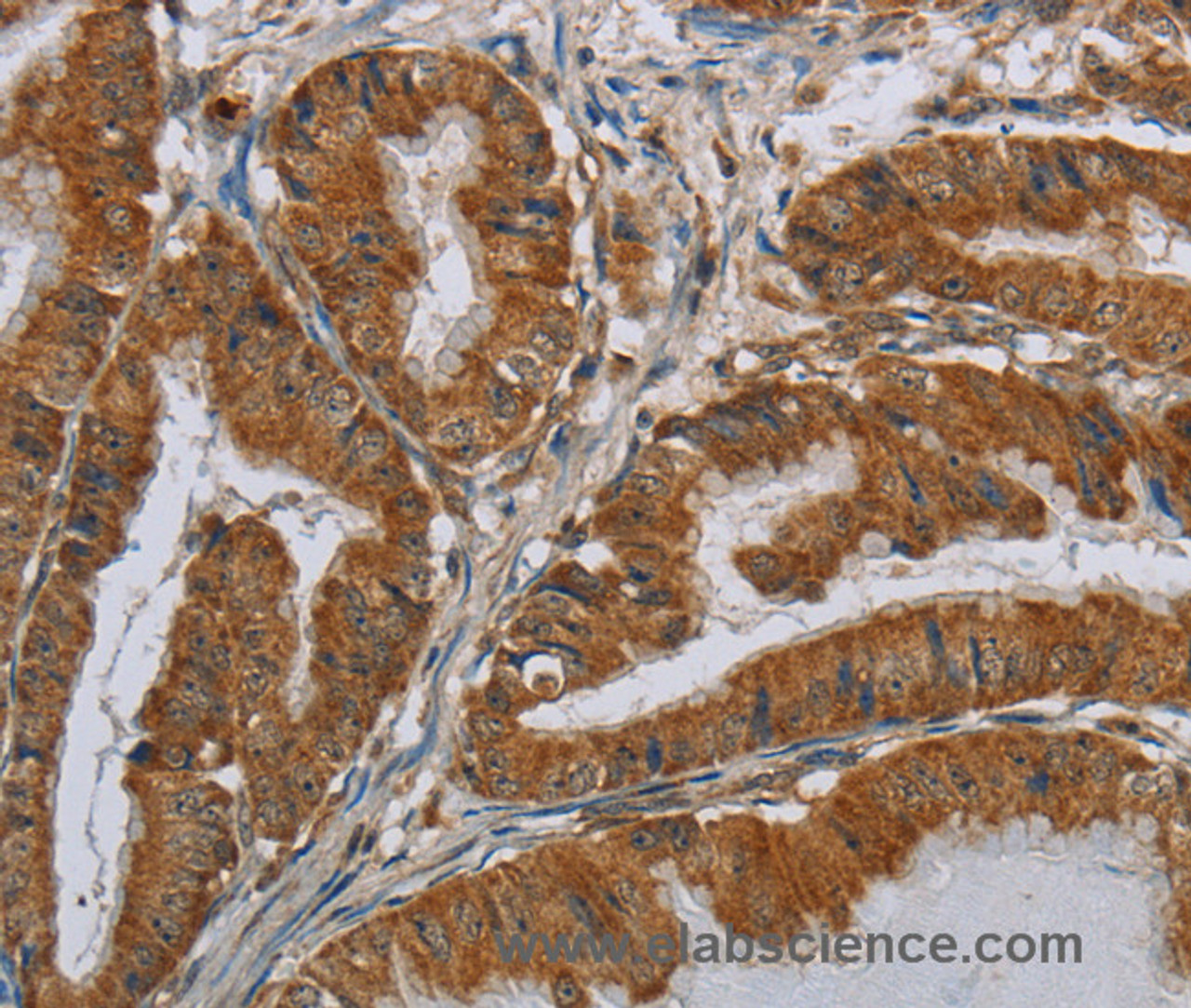 Immunohistochemistry of paraffin-embedded Human esophagus cancer using CSH1 Polyclonal Antibody at dilution of 1:40