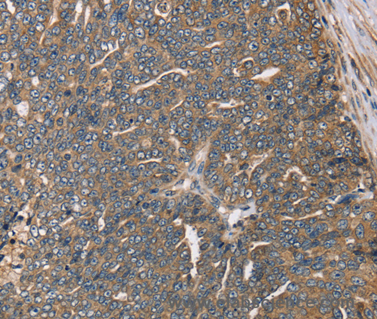 Immunohistochemistry of paraffin-embedded Human cervical cancer using HSD17B12 Polyclonal Antibody at dilution of 1:30