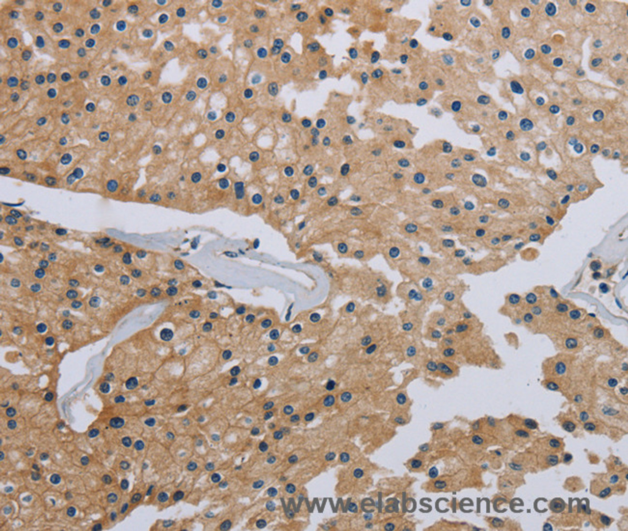 Immunohistochemistry of paraffin-embedded Human prostate cancer tissue using HSD3B7 Polyclonal Antibody at dilution 1:40