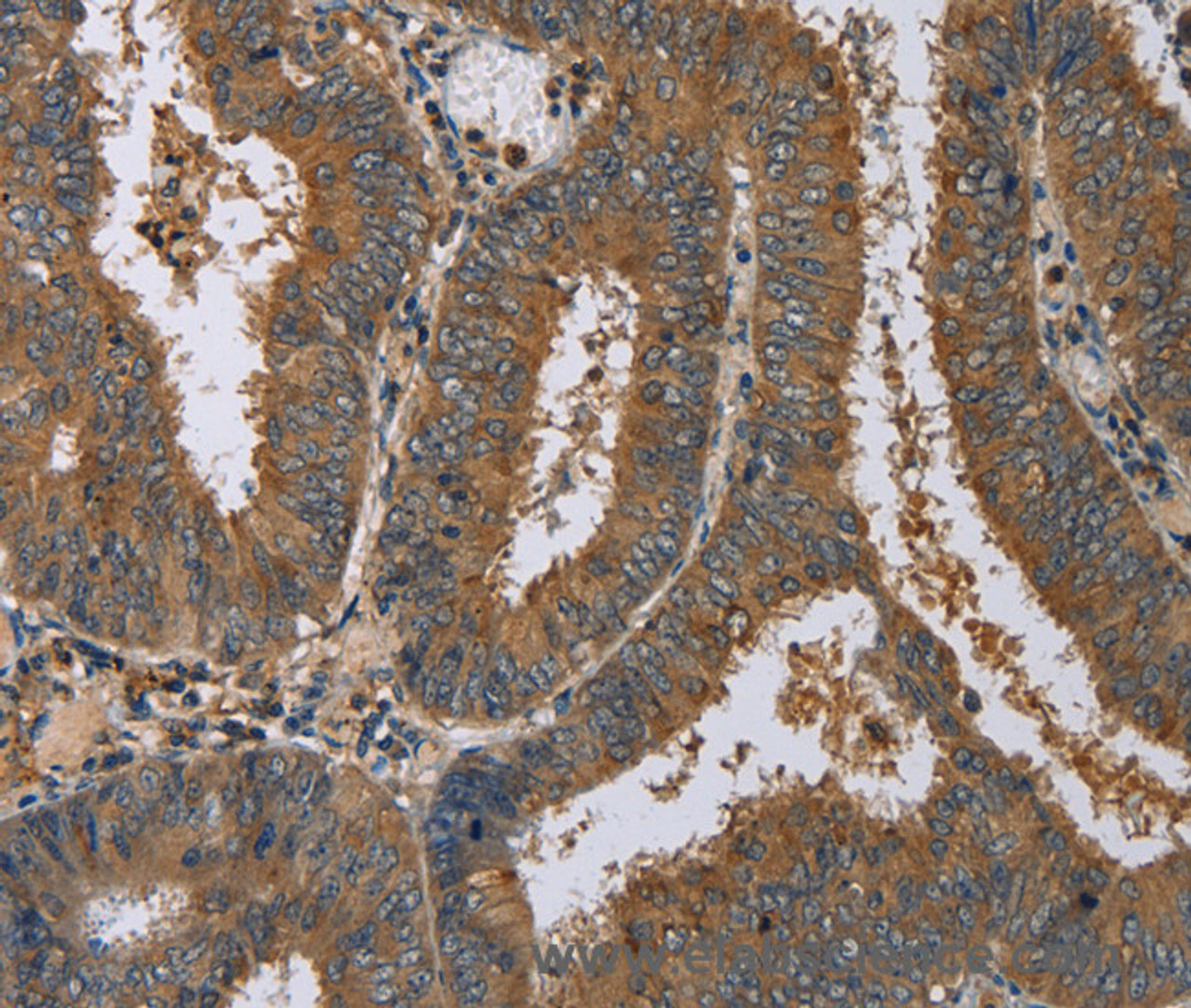 Immunohistochemistry of paraffin-embedded Human colon cancer using HSP40-4 Polyclonal Antibody at dilution of 1:60