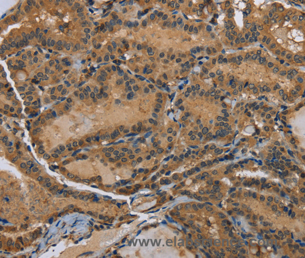 Immunohistochemistry of paraffin-embedded Human thyroid cancer using HSP40-4 Polyclonal Antibody at dilution of 1:60