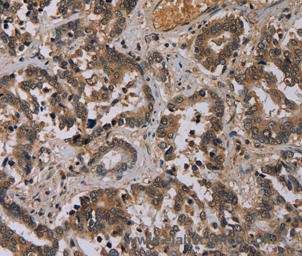 Immunohistochemistry of paraffin-embedded Human liver cancer tissue using CD242 Polyclonal Antibody at dilution 1:30