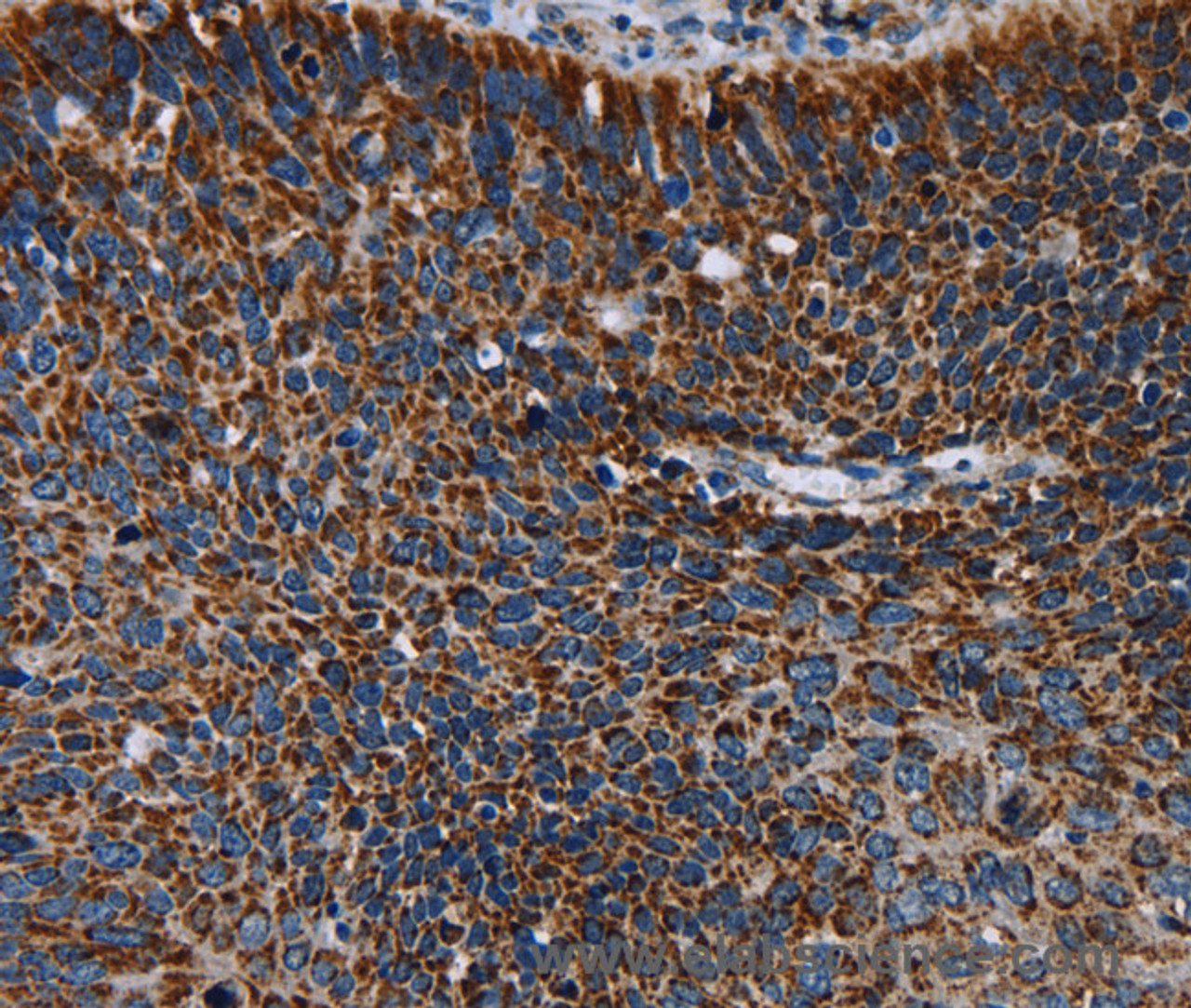 Immunohistochemistry of paraffin-embedded Human cervical cancer using IDH2 Polyclonal Antibody at dilution of 1:60