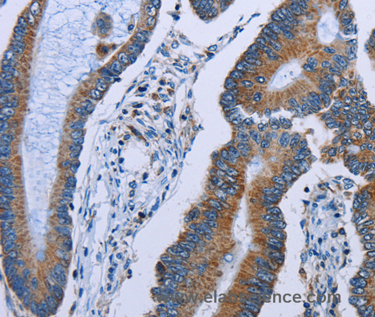 Immunohistochemistry of paraffin-embedded Human colon cancer using IDH2 Polyclonal Antibody at dilution of 1:60