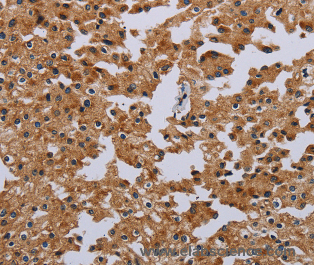 Immunohistochemistry of paraffin-embedded Human prostate cancer tissue using IFRD1 Polyclonal Antibody at dilution 1:40