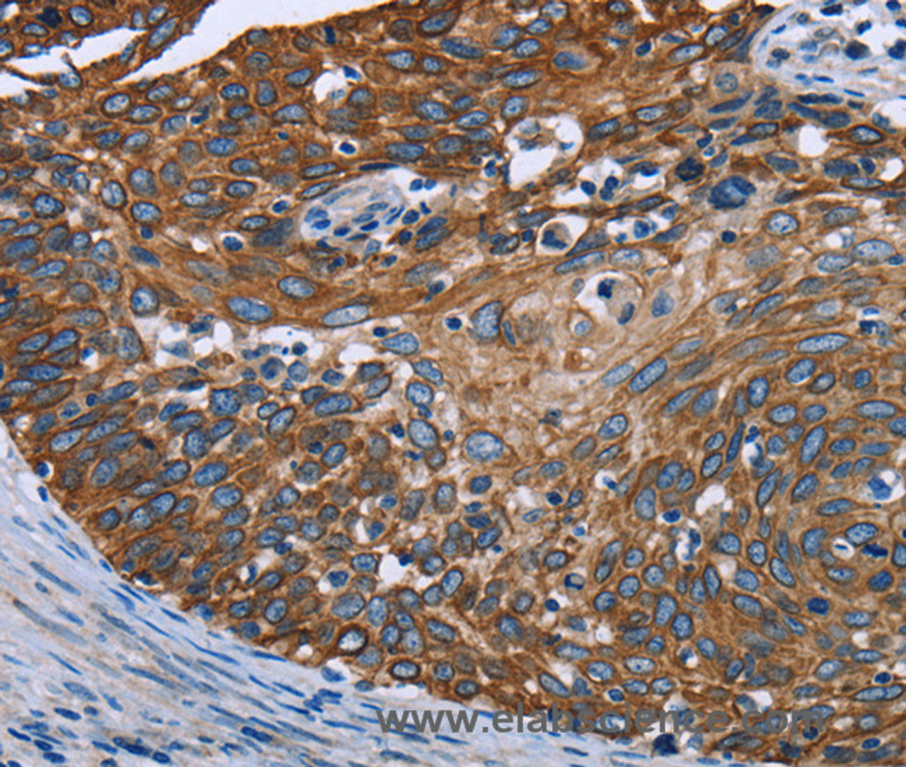 Immunohistochemistry of paraffin-embedded Human cervical cancer tissue using FCGR3A Polyclonal Antibody at dilution 1:40