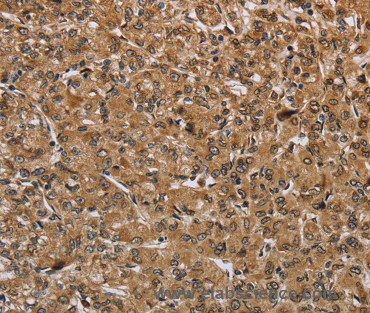 Immunohistochemistry of paraffin-embedded Human prostate cancer tissue using IKBIP Polyclonal Antibody at dilution 1:40
