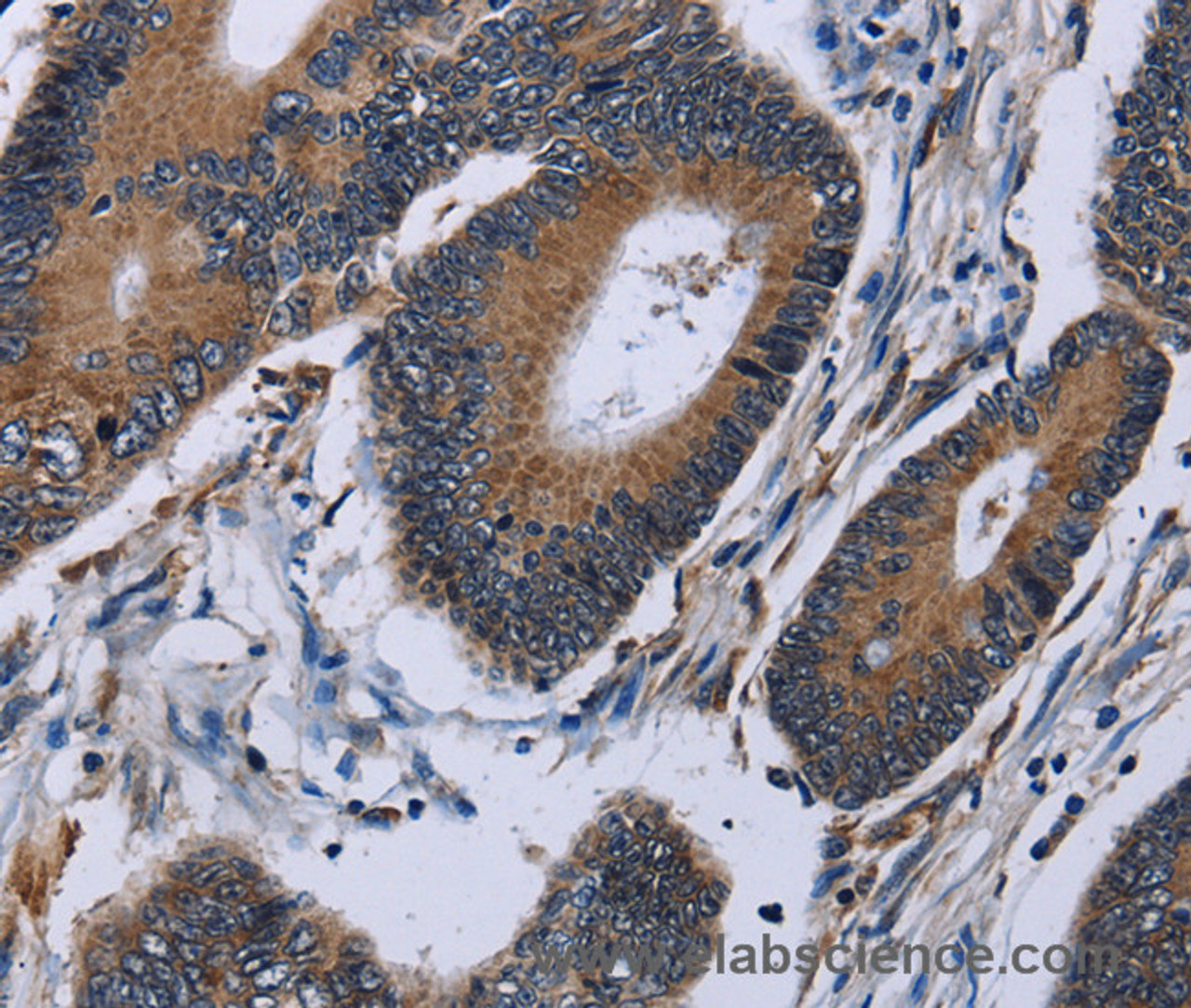 Immunohistochemistry of paraffin-embedded Human colon cancer using IPO4 Polyclonal Antibody at dilution of 1:50