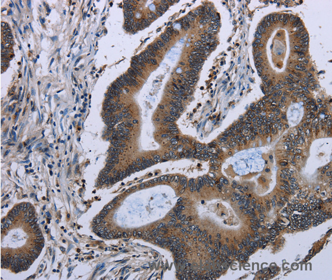 Immunohistochemistry of paraffin-embedded Human ovarian cancer tissue using ITGAE Polyclonal Antibody at dilution of 1:50